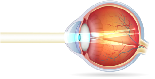 Astigmatisme-Ophtalmo-La-Meuse