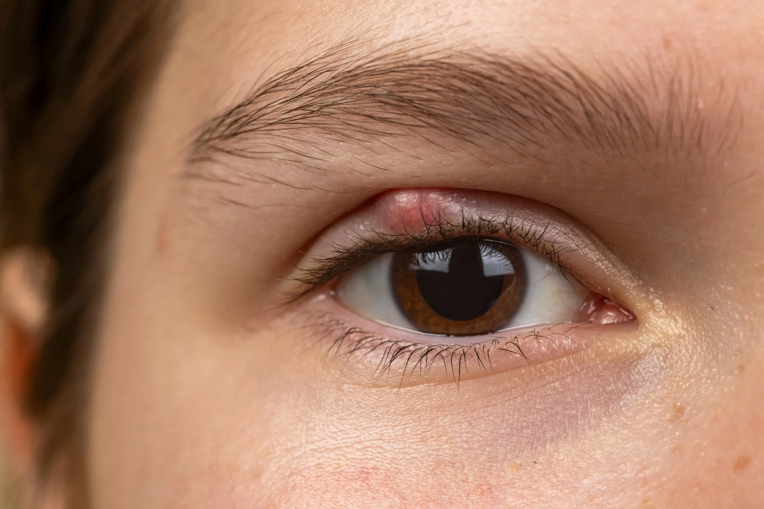 Chalazion-Ophtalmo-La-Meuse