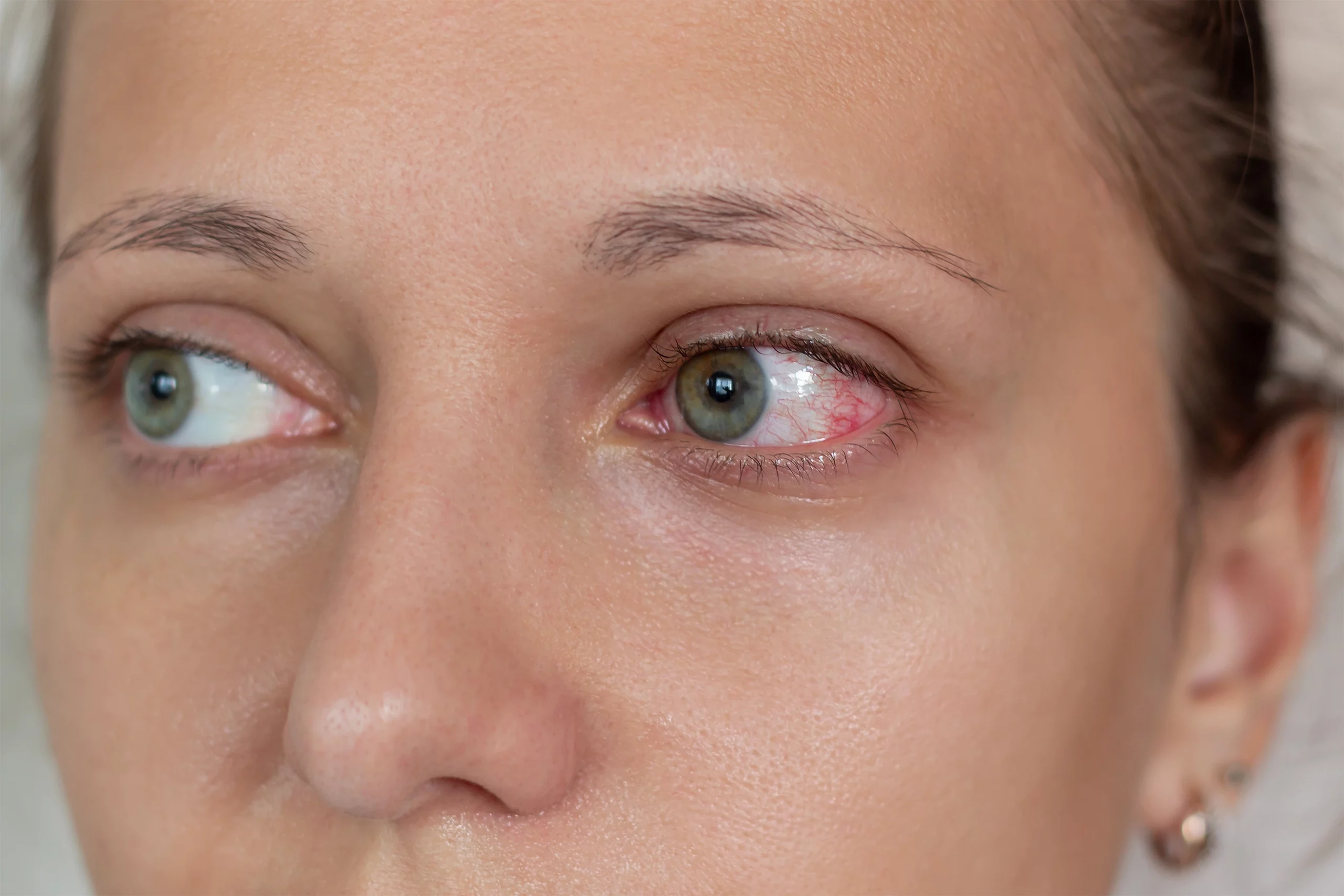 Comprendre-luveite-Uveite-Ophtalmo-La-Meuse
