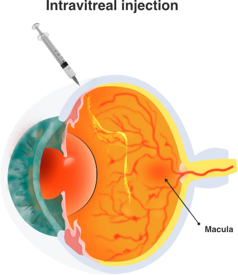 IVT-Ophtalmologie-La-Meuse