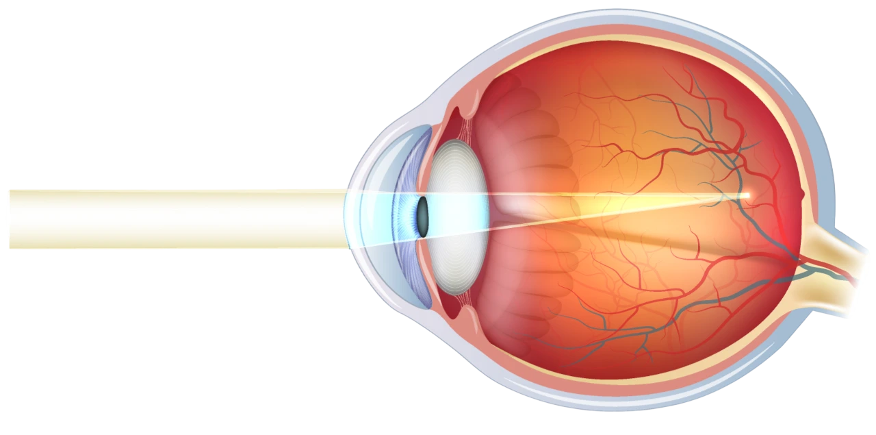 La-myopie-Ophtalmologie-La-Meuse
