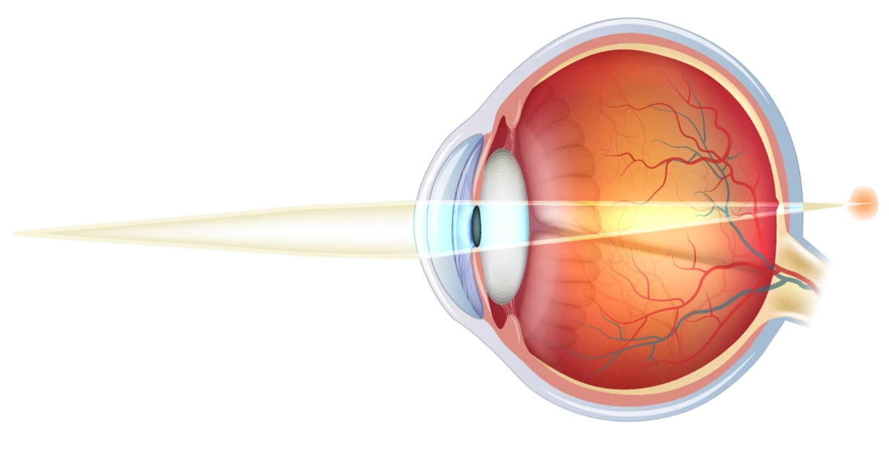 La-presbytie-Ophtalmologie-La-Meuse