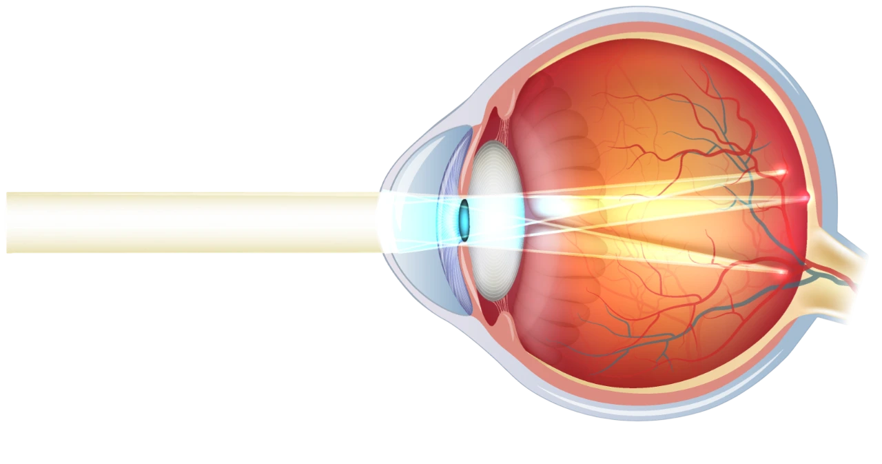 Lastigmatisme-Ophtalmologie-La-Meuse