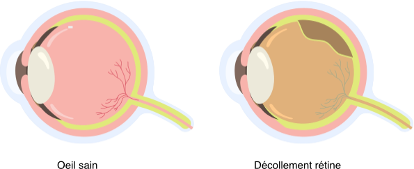 Les-pathologies-retiniennes-La-Meuse