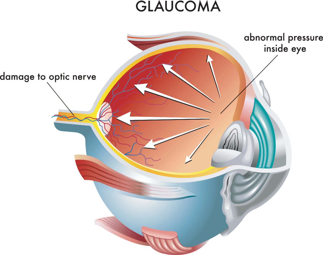Maladies-oculaires-Glaucome-Ophtalmologie-La-Meuse