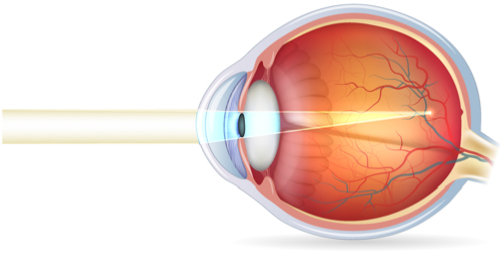 Myopie-Ophtalmologie-La-Meuse