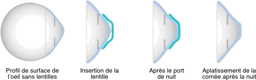 Orthokeratologie-La-Meuse