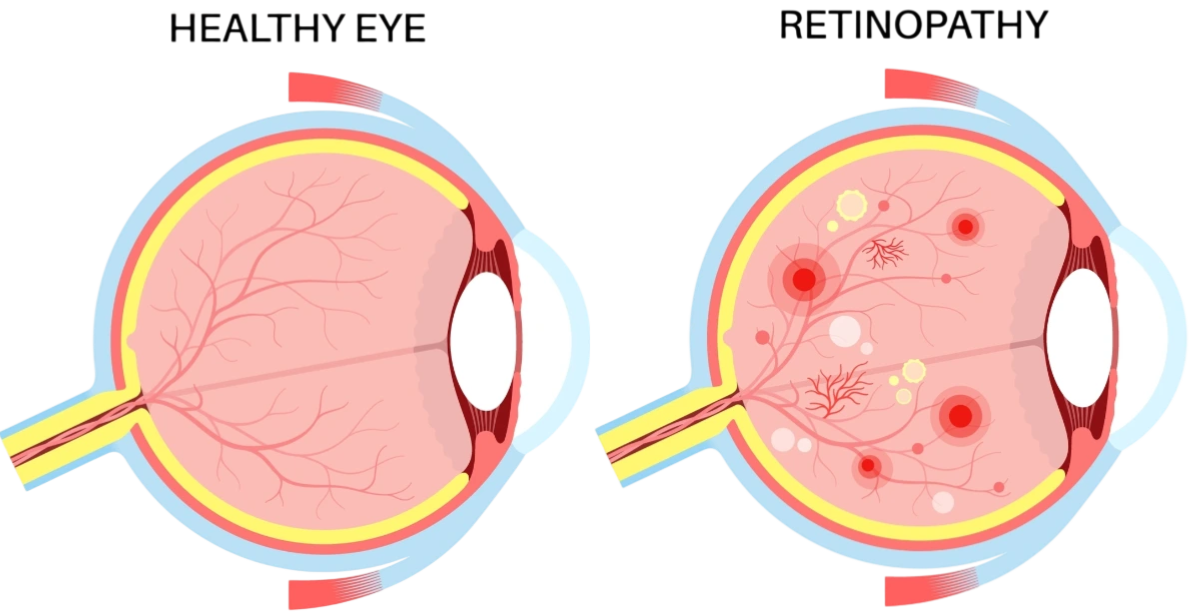 Retine-diabetique-Cabinets-Ophtalmo-La-Meuse