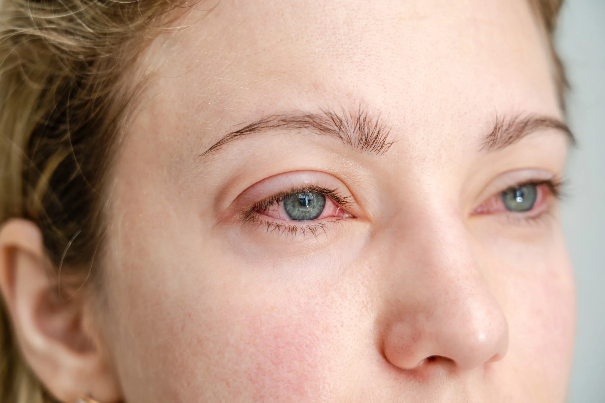 Secheresse-oculaire-Ophta-La-Meuse